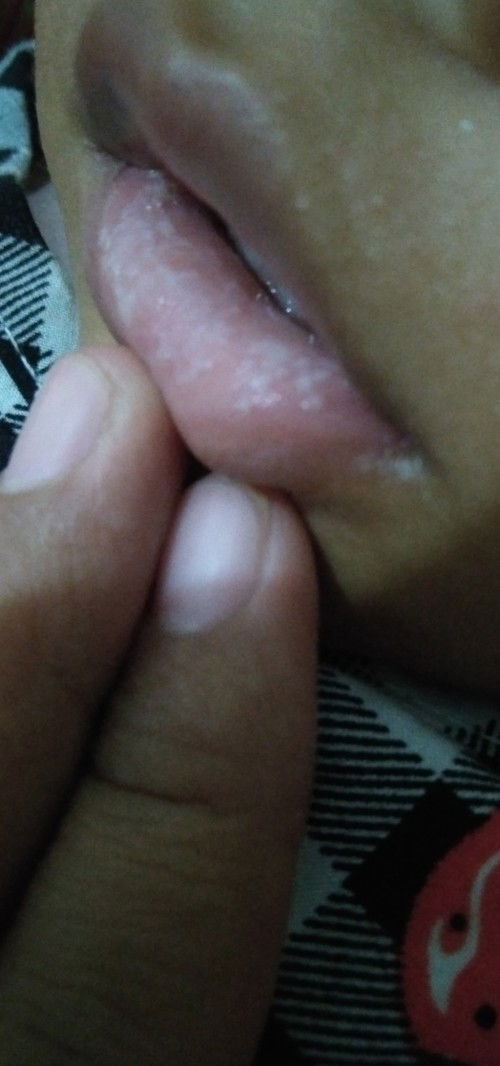 Bercak putih dibibir anak