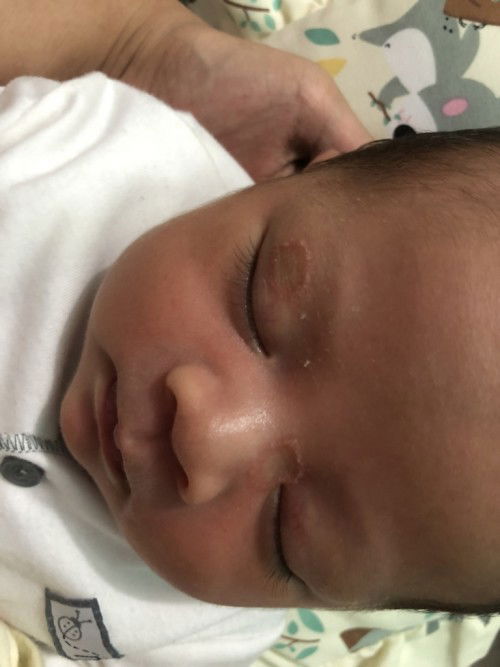 luka di dekat mata bayi 17hari