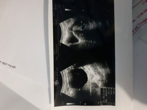 พบซีสในรังไข่ตอนท้อง