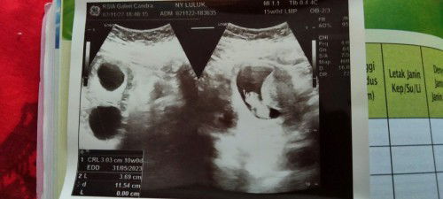ada kista saat usg