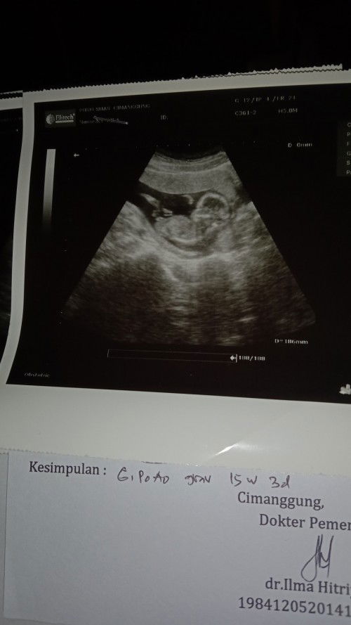 Perhitungan usia kehamilan hasil usg & hpht berbeda