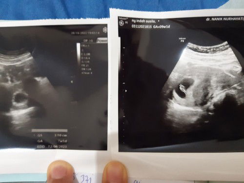 Hasil USG bidan dan dokter beda usia