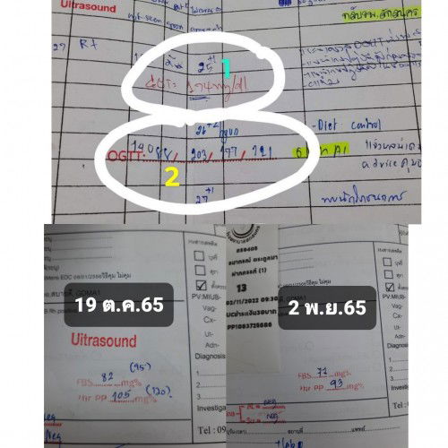 คุณแม่เป็นภาวะเบาหวานขณะตั้งครรภ์ 25w1d