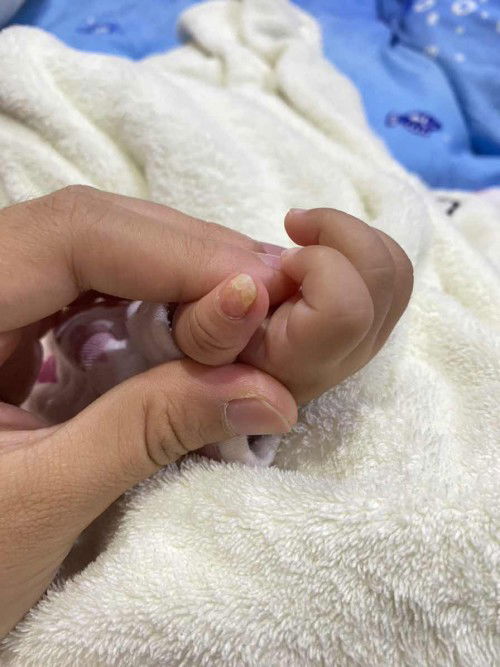 เล็บลูกเป็นแบบนี้ ทำไงถึงหาย