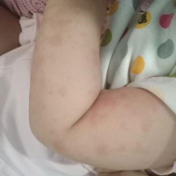 Ruam merah pada kulit bayi 10 bulan