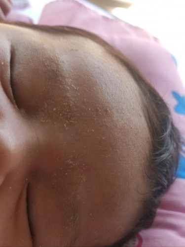 light yelow2 sa scalp at kilay Normal ba? 1month and 5dys