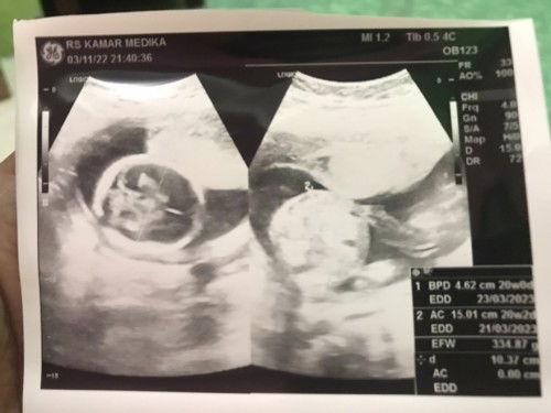 Usg di 20minggu