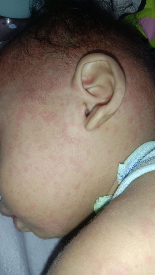 Bun boleh tanya" sedikit dan berbagi pengalaman 
Gabaken(bintik bintik merah)