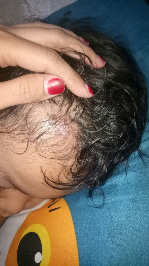 Luka apa dan apa obat nya