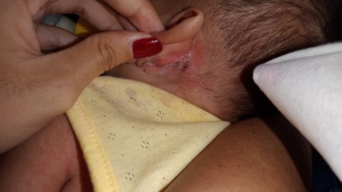 Bunda ada yang pengalaman, daun telinga belakang si kecil ada belatungnya tidak ya