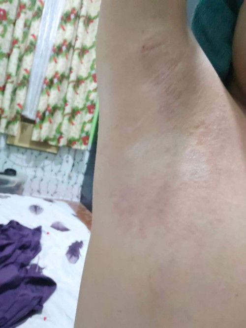 RASHES BOTH SIDE SA MAY DEDE PA KILIKILI