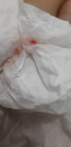 Mau tanya kenapa ya dari awal hamil aku keluar darah terus ingusnya, kalo upil ada darah keringnya