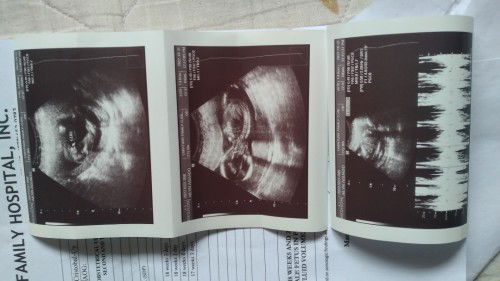 Im now on my 18w&5d nagwoworry lang ako kasi Frank Breech sya ok lang po un?