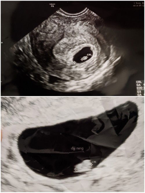 Keguguran pada Minggu ke-10