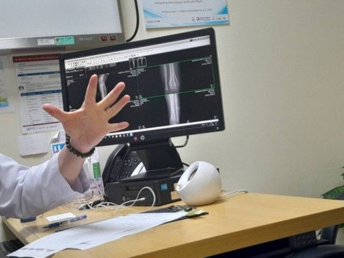 ตรวจเจอว่าเป็นกระดูกขาใหญ่ข้างใน พบในวัย10เดือน 19 วัน