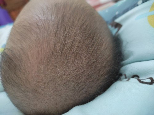 Kulit kepala bayi banyak ketombe