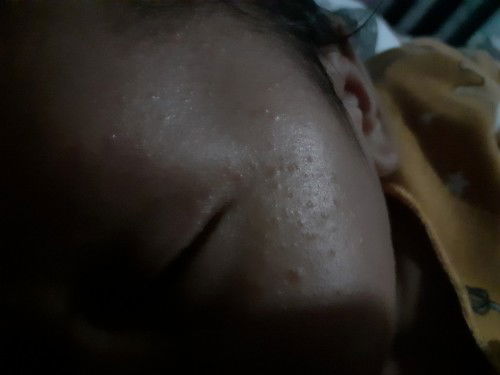 Seperti bruntusan atau biang kringat