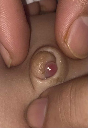 granuloma umbilical
