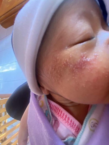 Pipi merah dan kayak berjerawat