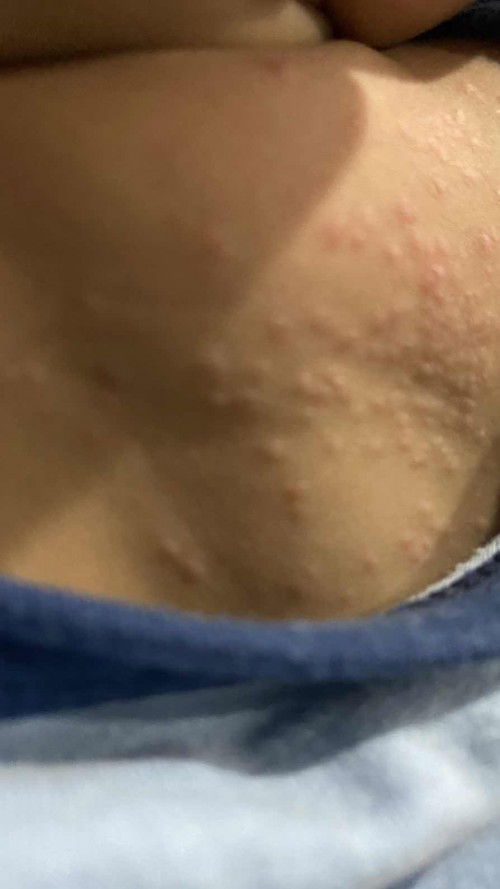 ruam atau alergi ye?