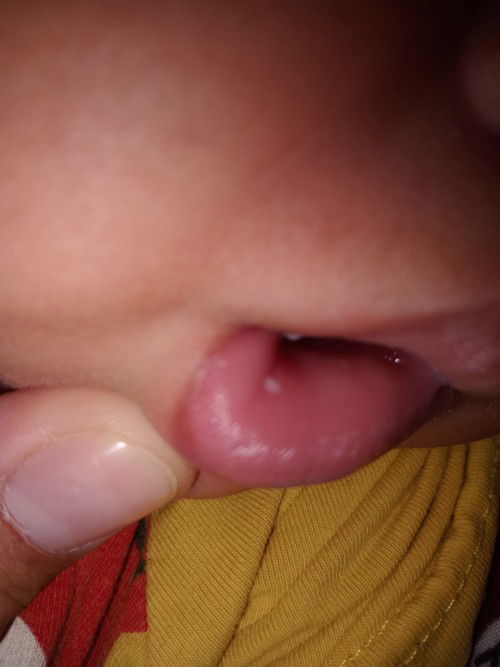 มีใครรู้บอกหน่อยน้าน้องพึ่งเป็นแบบนี้ใครปากต้องทำไงบ้างคะอยู่ที่ลิ้นก็มีจ่ำแดงๆใครรู้บอกหน่อยน้า