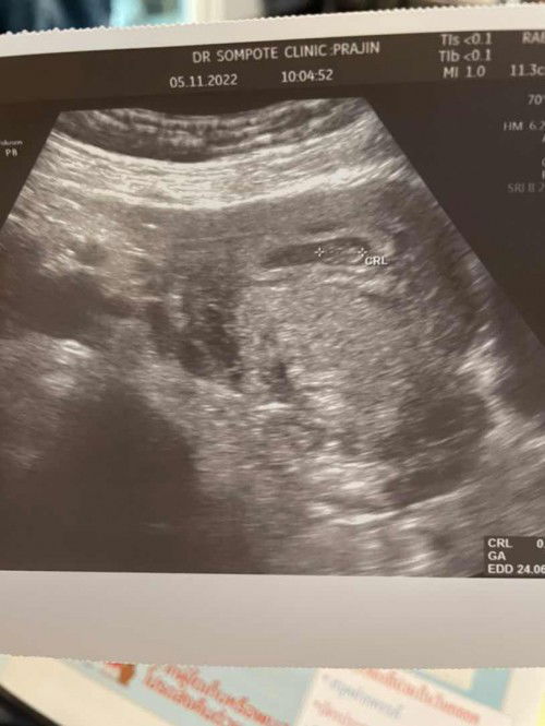 7w2D เจ้าเม็ดถั่วตัวน้อย