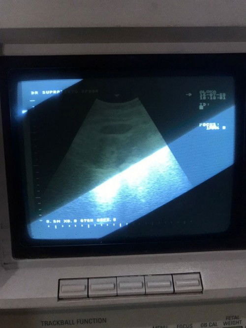 Bunda bunda mau tanya hasil USG