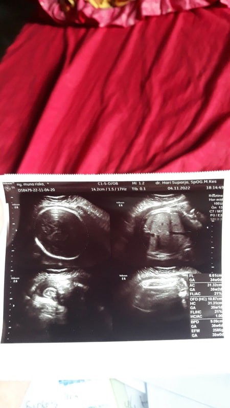 Air ketuban berkurang usia kandungan 37week & bbj 2,6