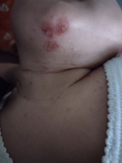 Bunda mau tanya kalo kaya gini diobatin apa ya? Sudah tak kasih krim beem tadinya kering tapi nnti s