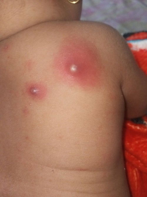 Benjolan seperti bisul