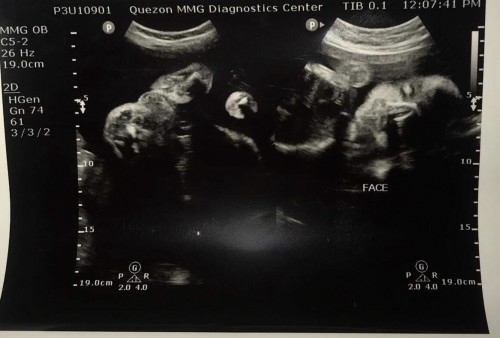 Boy or girl?