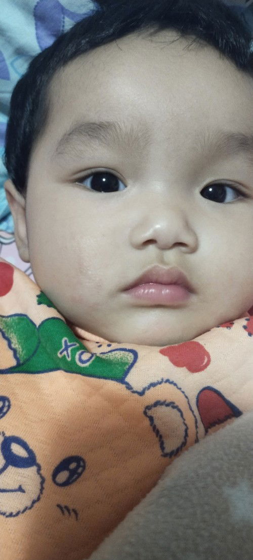 หน้าน้องเป็นผื่นแดงๆๆ