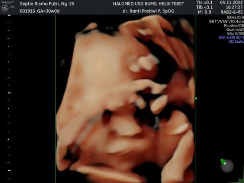 USG di Halomed Helix Tebet x Dr. Ranti Pratiwi