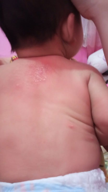 BADAN BAYI BERBINTIK BINTIK NANAH