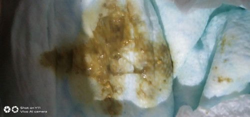 Ito po Ang poop Ng baby ko 3 months old pa po, nestugen 0-6 months user po, normal lang po ba?