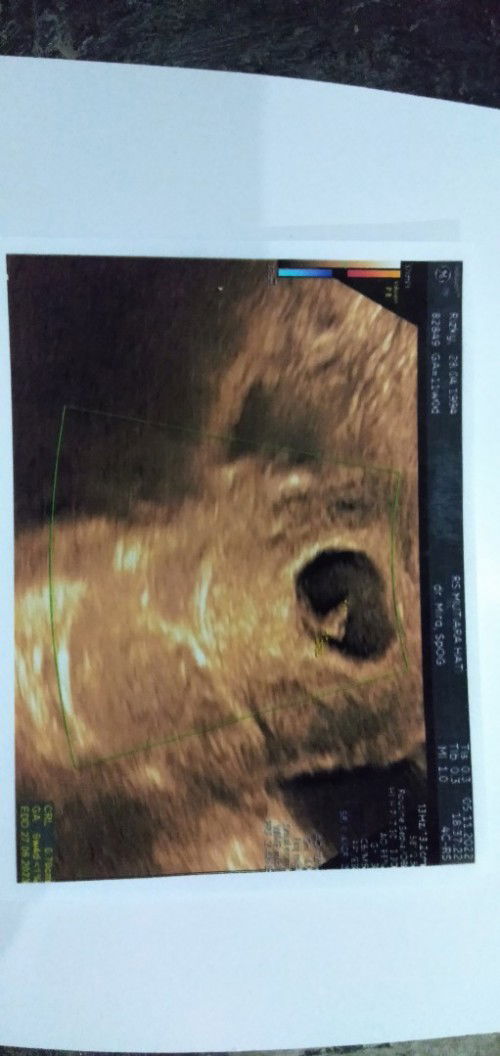 Janin tidak berkembang