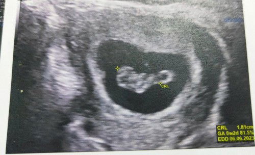 ท้อง9w+ไทรอยด์เป็นพิษ