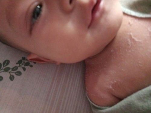 kulit mengelupas pada bayi 5bulan.