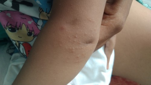 bintik2 di kaki dan tangan anak