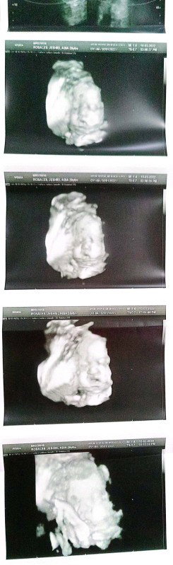 39 weeks and 2days sa unang ultrasound. BPS 38 Weeks and 2days.