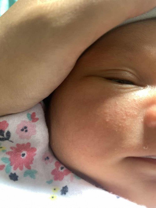 Muka bintik bintik merah