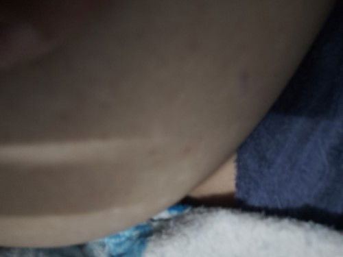 ขอสอบถามหน่อยค่ะท้องเเตกลายมีตุ้มเล็กๆเหมือนเป็นจุดสีส้มเกิดขึ้นเป็นอาการปกติใช่ไหมค่ะ