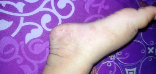 Gatal gatal pada kulit