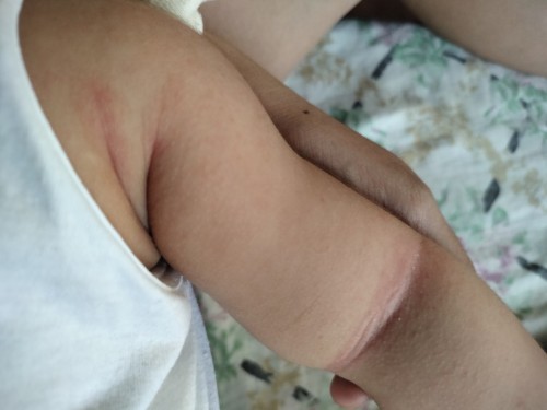 BabyRash..