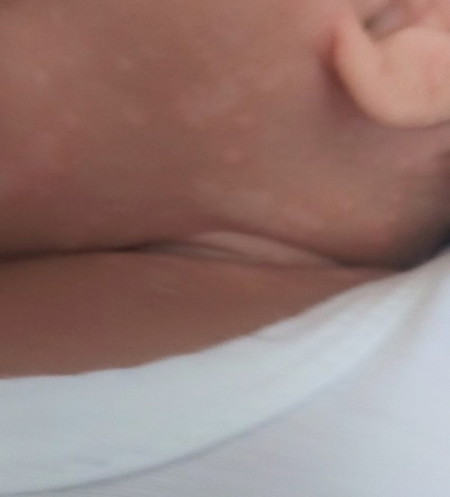 Ano po kaya itong nasa leeg ni baby na puti puti po? Ano po kaya gamot dito? Mag 2 month po si baby.