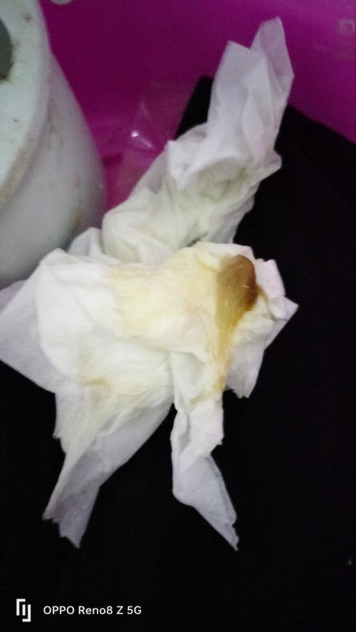 38+2มีหมูกน้ำตาลป่นเลือดปั้นถี่เจ็บท้องนิดหน่อยต้องไปหาหมิเลยไหมค่ะ