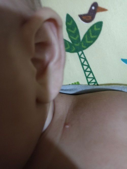 Bintik bernanah pada bayi 2bulan 10hari