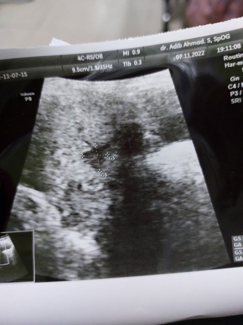 Hamil BO Dan sekarang hamil lagi 6week