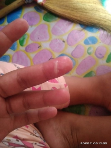 36 weeks Discharge
