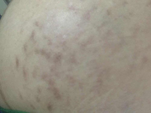 Menghilang bekas Stretchmark